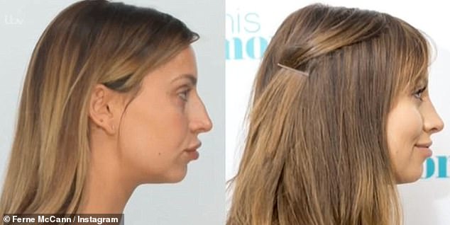 In 2016, Ferne revealed she had a nose job, which she unveiled the results of during an appearance on This Morning after the operation