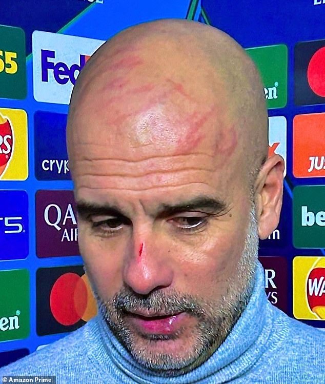 Pep Guardiola was left with a number of cuts and marks after Man City's draw with Feyenoord. He admitted he scratched himself and made comments about self harm, which he later clarified