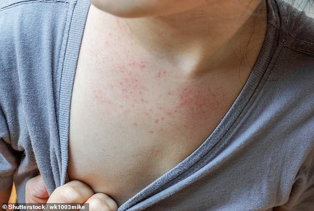 There is one other sign of the condition that also differs from a cold or flu that could indicate people have contracted hMPV. Experts say a rash on the skin may be an early sign of infection