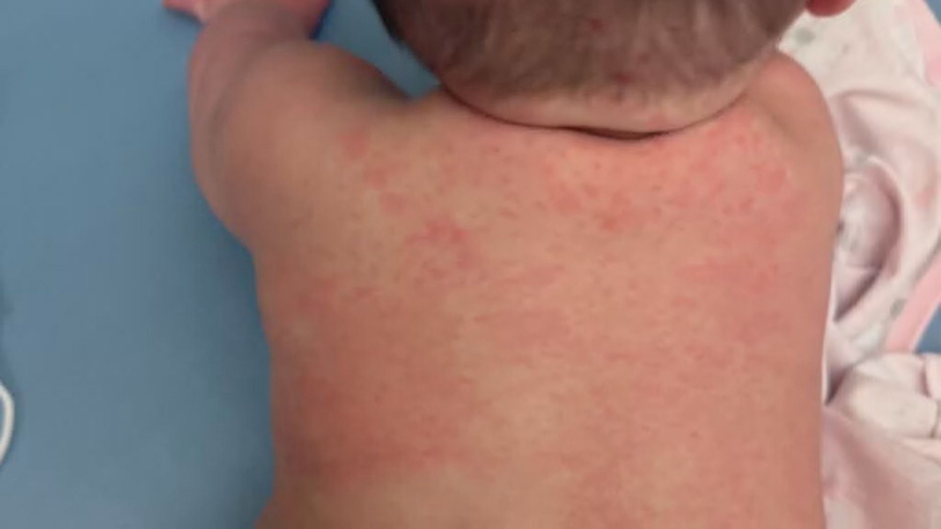 Click to play video: 'Alberta mother urges everyone to get measles vaccine after baby hospitalized'