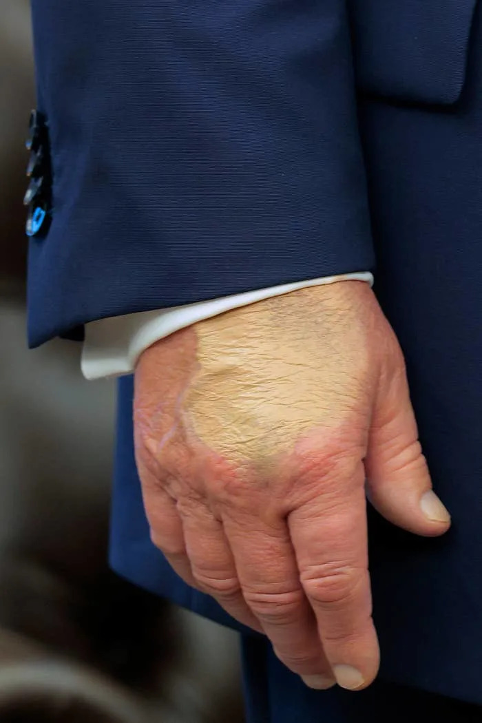 A close-up of a person's hand with makeup covering a bruise on the back, partially visible below a suit sleeve