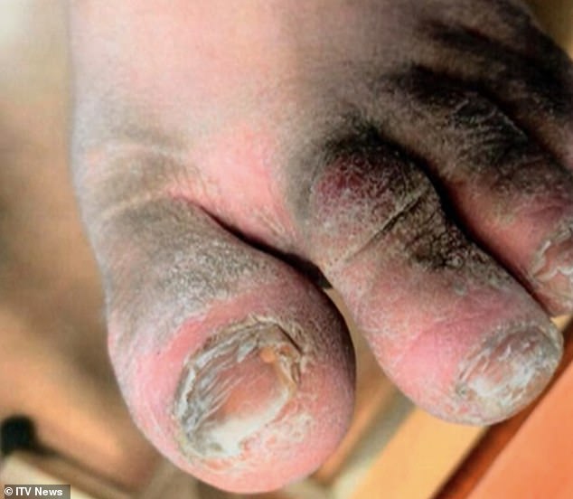 The final straw for Steven's father John was noticing that his son's foot had turned black as the result of an untreated infection - requiring urgent hospital treatment