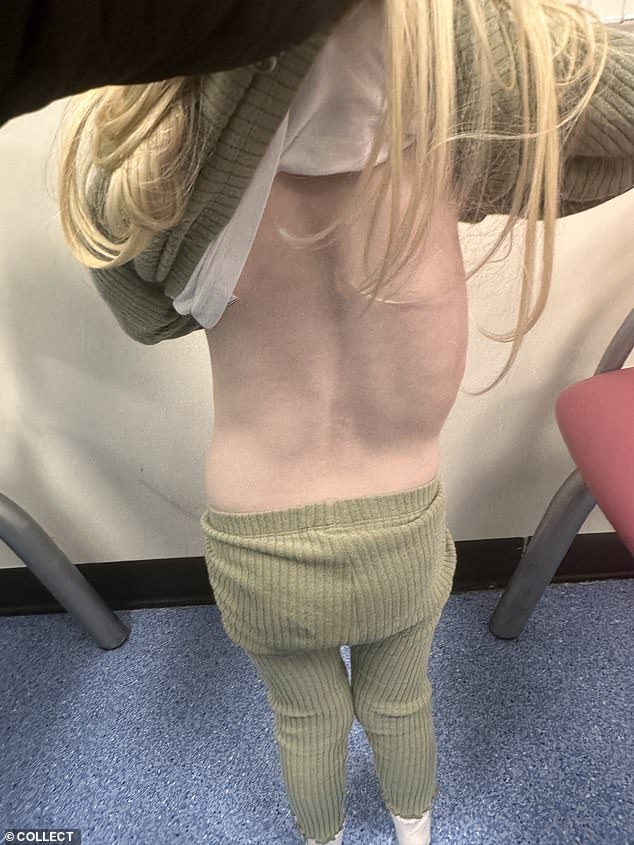 The incident left her with a condition known as accident induced scoliosis that causes curvature of the spine which worsened over time
