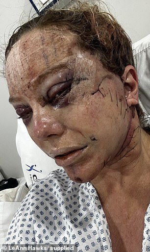 One day after surgery, the fog began to lift and nurses carefully removed her bandages, but looking in the mirror, LeAnn (pictured days after surgery) said: 'it was the most horrific thing I have ever seen'