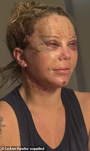 One day after surgery, the fog began to lift and nurses carefully removed her bandages, but looking in the mirror, LeAnn (pictured days after surgery) said: 'it was the most horrific thing I have ever seen'